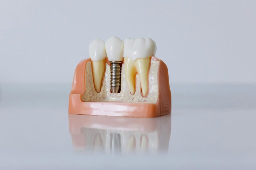 Implante Dental